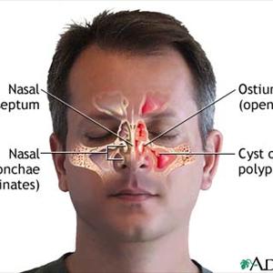  Beat Sinusitis With Sinus Medication Topical Therapy