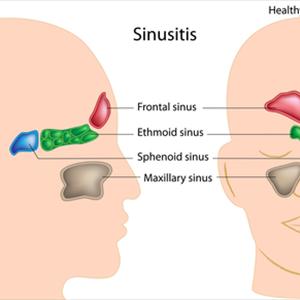 Herbal Pills To Stop Food Allergies With Sinus Pain 