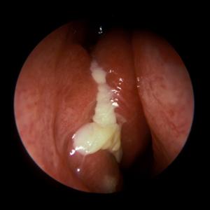 Can A Sinus Infection Cause Pain In The Larynx - Nebulized Sinus Treatment: New Treatment Option For Your Sinusitis