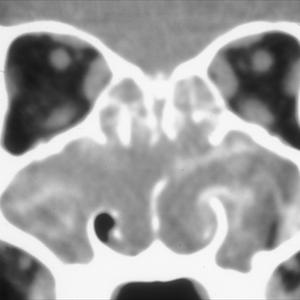 Sinus Infections Dizziness - Sinus Nebulization: An Alternative Sinusitis Treatment