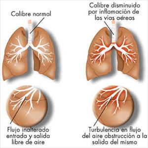 Ethmoid Sinus Headaches 