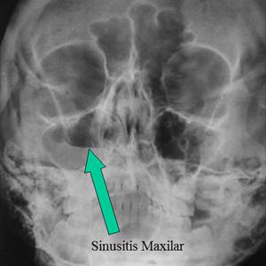 Riding The Sinuses Of Fungus Naturally - Resisting Chronic Sinus Infection