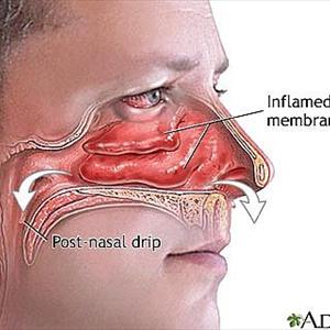 Unilateral Postnasal Drip - Home Remedies For Sinusitis Giving Awesome Results