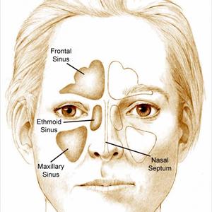  Sinusitis Discomfort