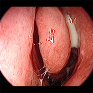 Nasal Irrigation - When Natural Sinusitis Cure Is Not Enough