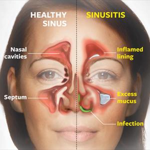 Headache Followed By Bloody Nose - Basic Information On Sinusitis Treatments