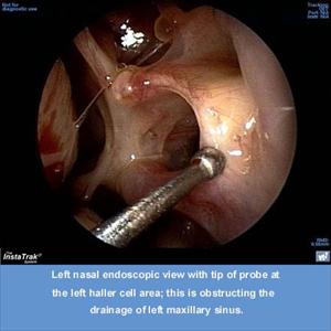 Treating Sinus Candida - What You Should Know About Serious Infection Of The Sinus