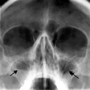 Infection De Sinus - Sinusitis