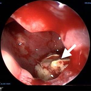 causes of sinus and ear infection