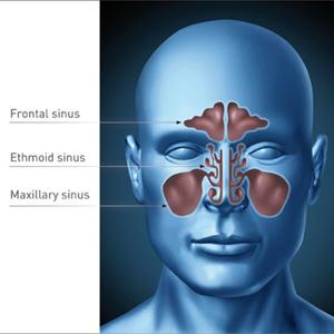 Sinusodor - Balloon Sinuplasty - The Actual Noninvasive Procedure