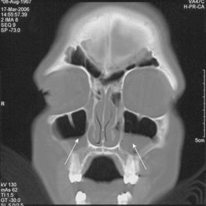 Sinuses Burning And Throbbing - Chronic Sinusitis - What To Look For