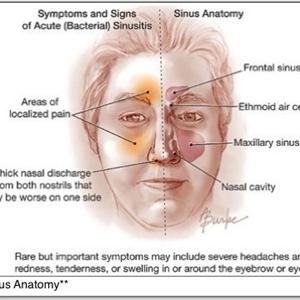 Sinusitis Extract Ingredients 