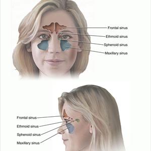 Home Remedies For Sinus Infections 