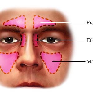 Cannot Get Rid Of Green Mucous In Sinuses 