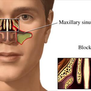 What Foods Not To Eat With Sinus Problems - The General View And Medical Explanation Of Bronchiectasis