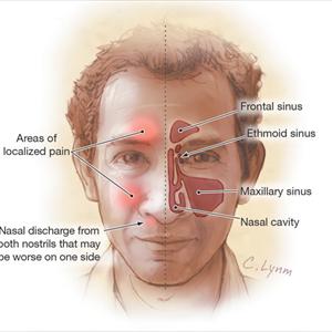 Herbal Remedies For Nasal Polyp - Fungal Sinusitis: 2 Guaranteed Medical Coding Formulas That Work