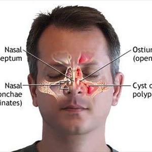 Natural Remedy Against Sinusitis 