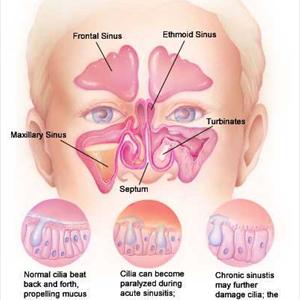 How To Moisten Nostrils - Sinusitis 101 - It