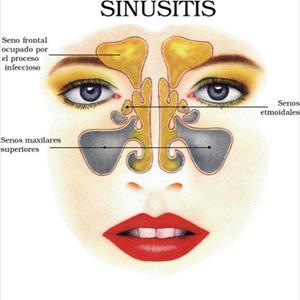 Natural Sinusitis Cures - Types Of Fungal Sinusitis