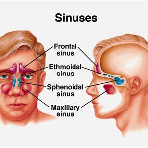 Natural Cure For Sinus Cyst 