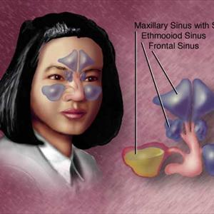 Sinusitis Herbal Remedy - Sinus Infection Facts: Why Treat Sinus Infection Earlier