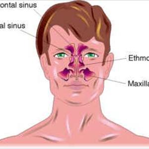 Cures For Severe Sinus Problems - Fungal Sinusitis Q&A