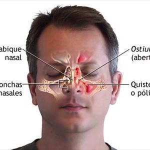 Tea Tree Oil Will Cure Sinusitis - Getting Infected Sinus Relief