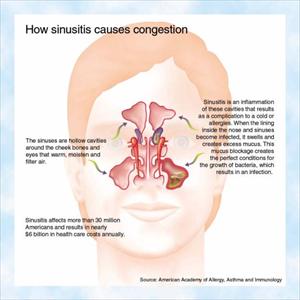  Bringing Nasal Problems To An End